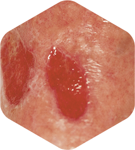 Ulcer varicos rosu curat