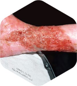 Ulcer varicos cu secretie moderata intensa fara infectie